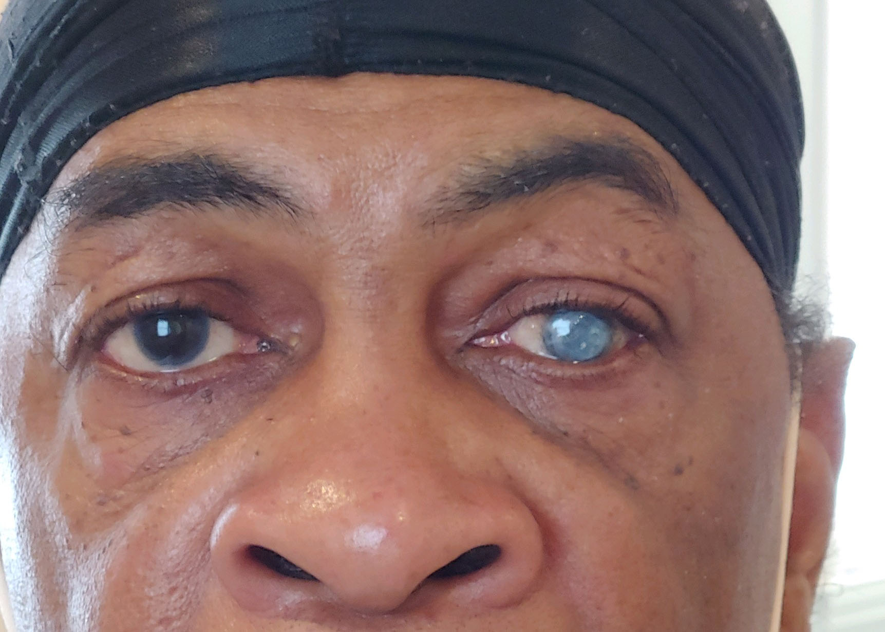 Prosthetic Eye Patient Photos