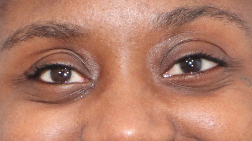 Will my Artificial Eye Look Real? – Artificial Eye Clinic