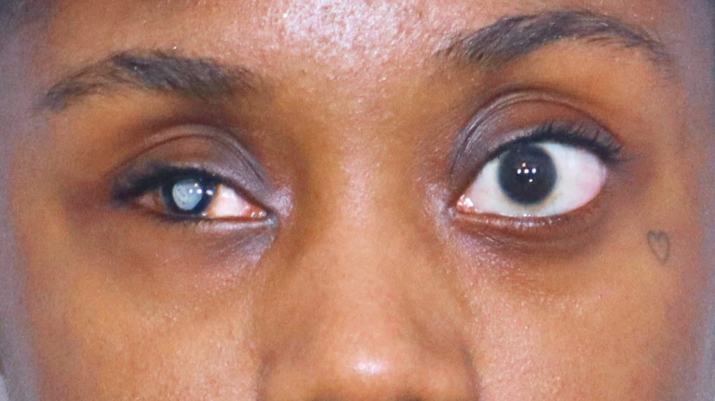 What Do Prosthetic Eyes Look Like?
