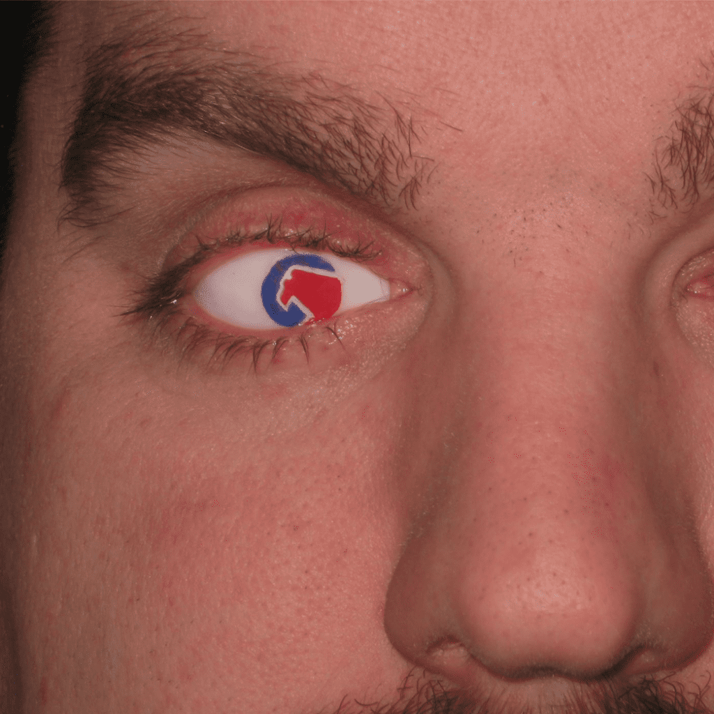 Prosthetic Eye Patient Photos | Carolina Eye Prosthetics